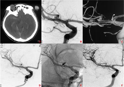 Stent-assisted coiling vs. coiling alone of ruptured tiny intracranial aneurysms: A contemporary cohort study in a high-volume center